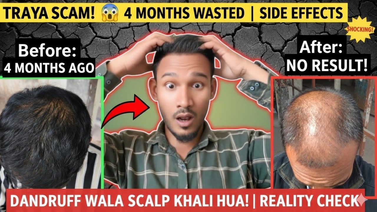 My 4 Months Traya Journey: Real Experience & Results! ❌ Scalp Reality Check