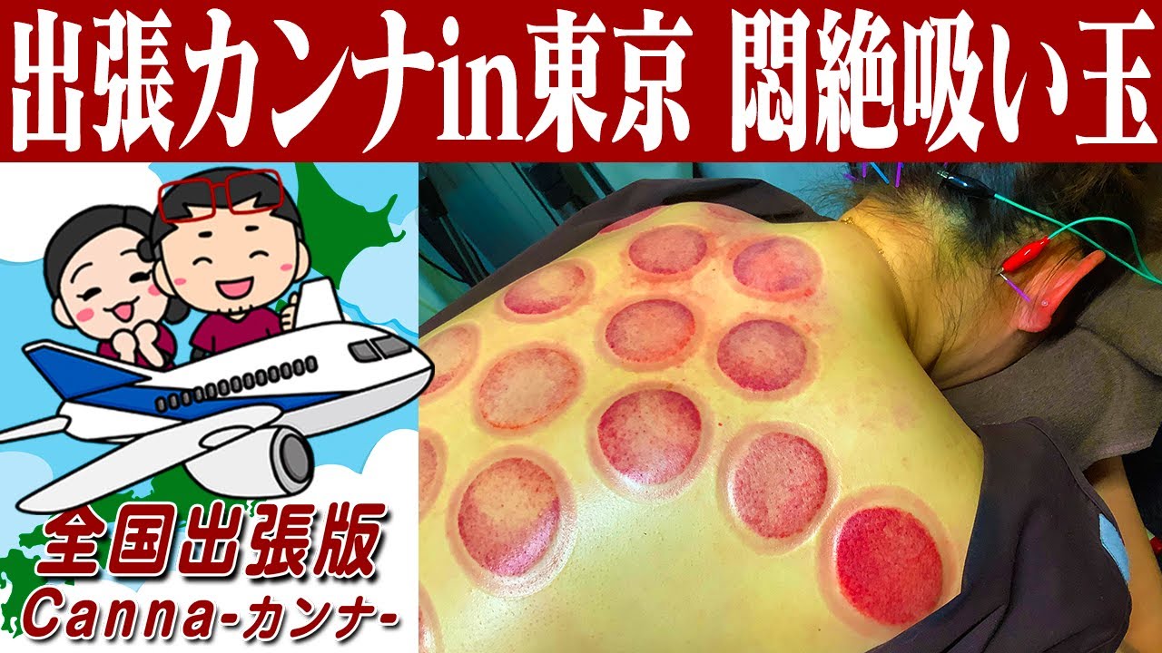 【吸い玉 肩こり】出張カンナin東京！ヤバい肩こりに悶絶初吸い玉！