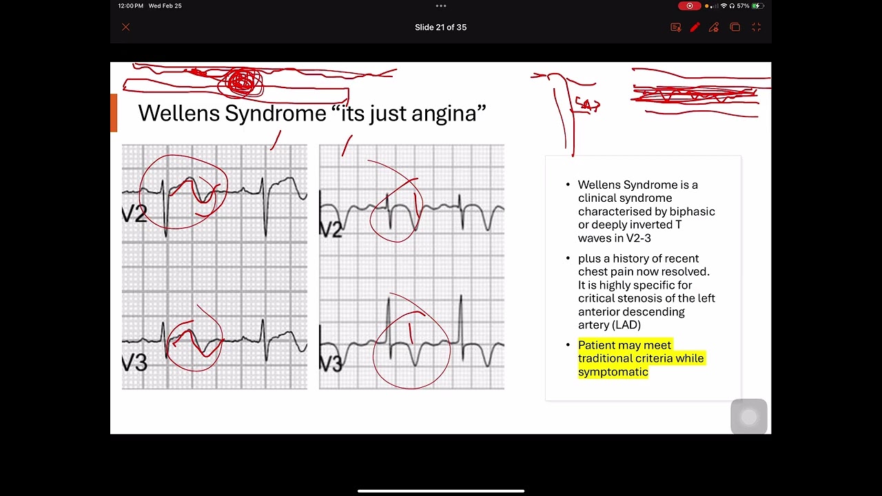 Intro to advanced 12 lead lecture 2