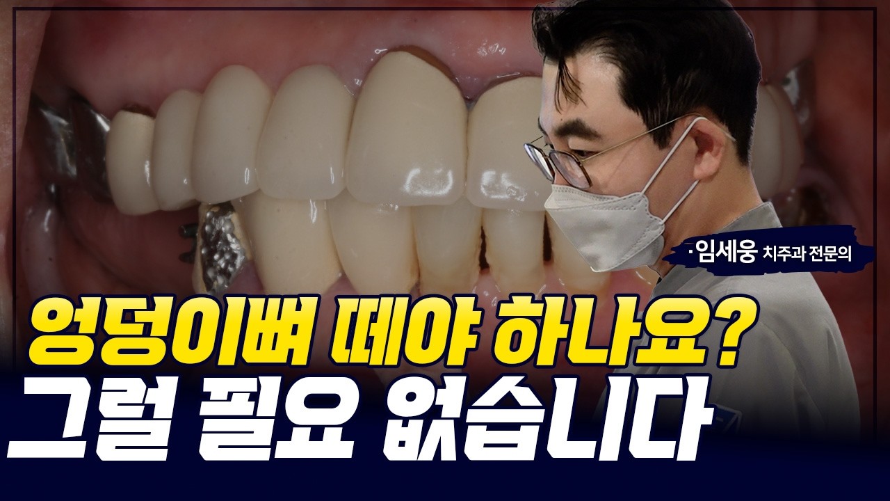 어금니 뼈 부족하면 엉덩이뼈까지 떼야 할까? #뼈이식임플란트 #어금니임플란트 #뼈이식