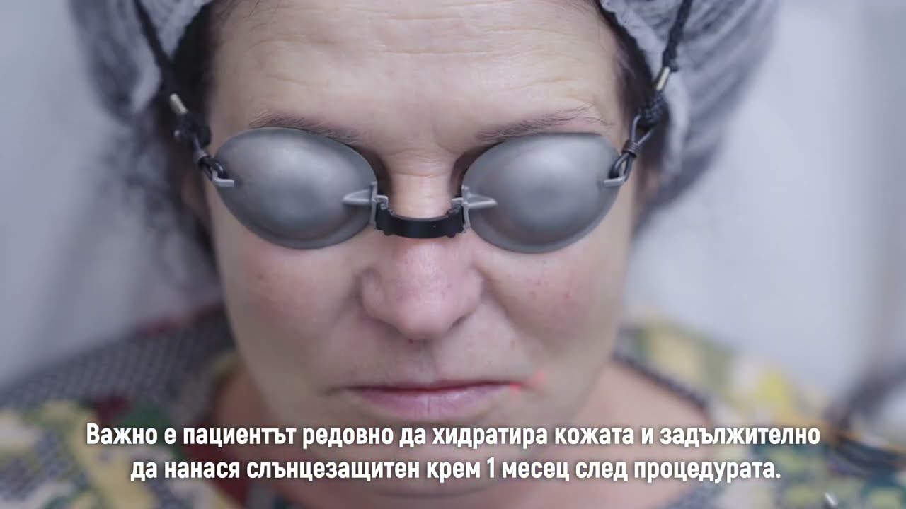 Youlaser MT - Рисърфисинг на лице и третиране на белези