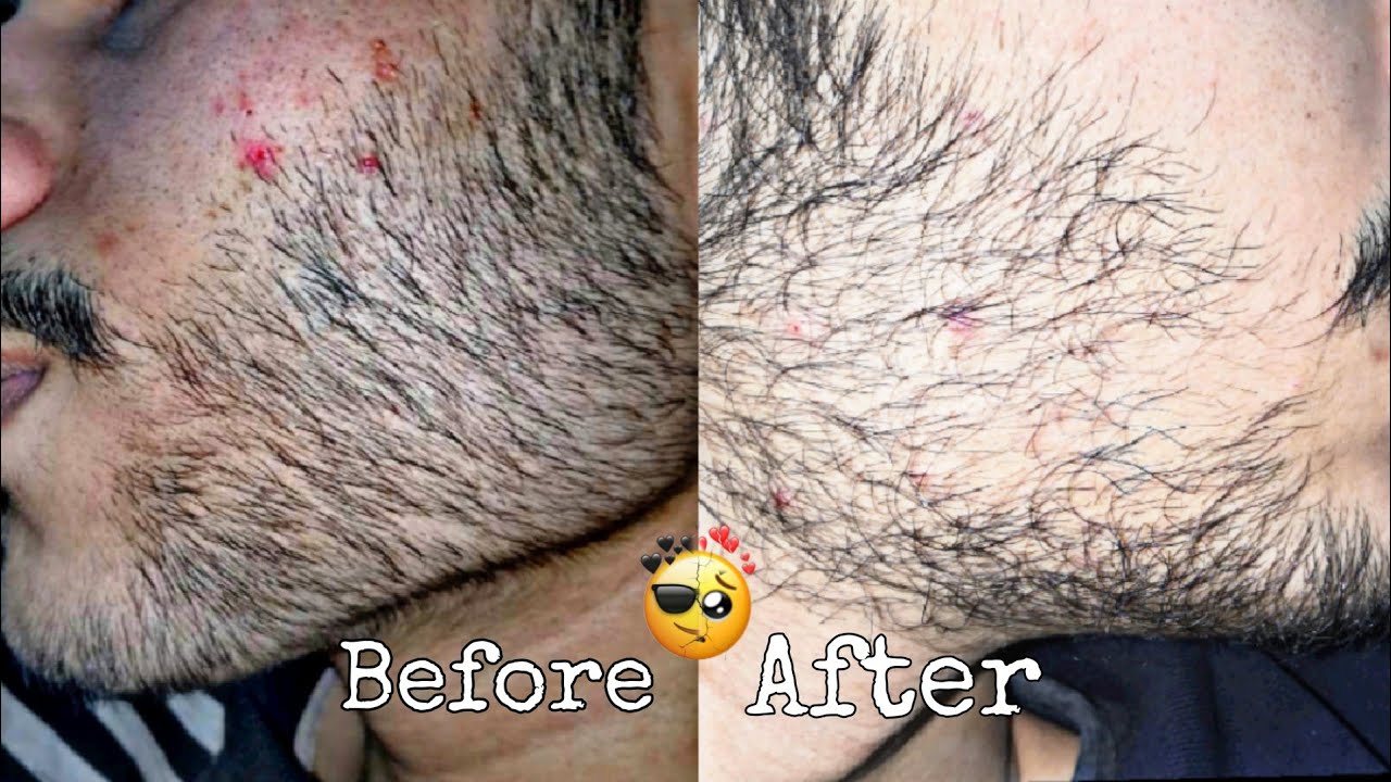 Minoxidil beard journey | I left the minoxidil