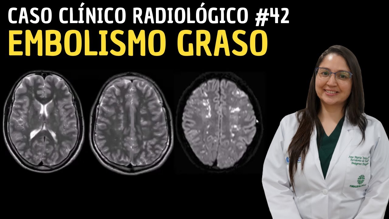 Caso Cl&iacute;nico Radiol&oacute;gico 42: Embolismo graso.