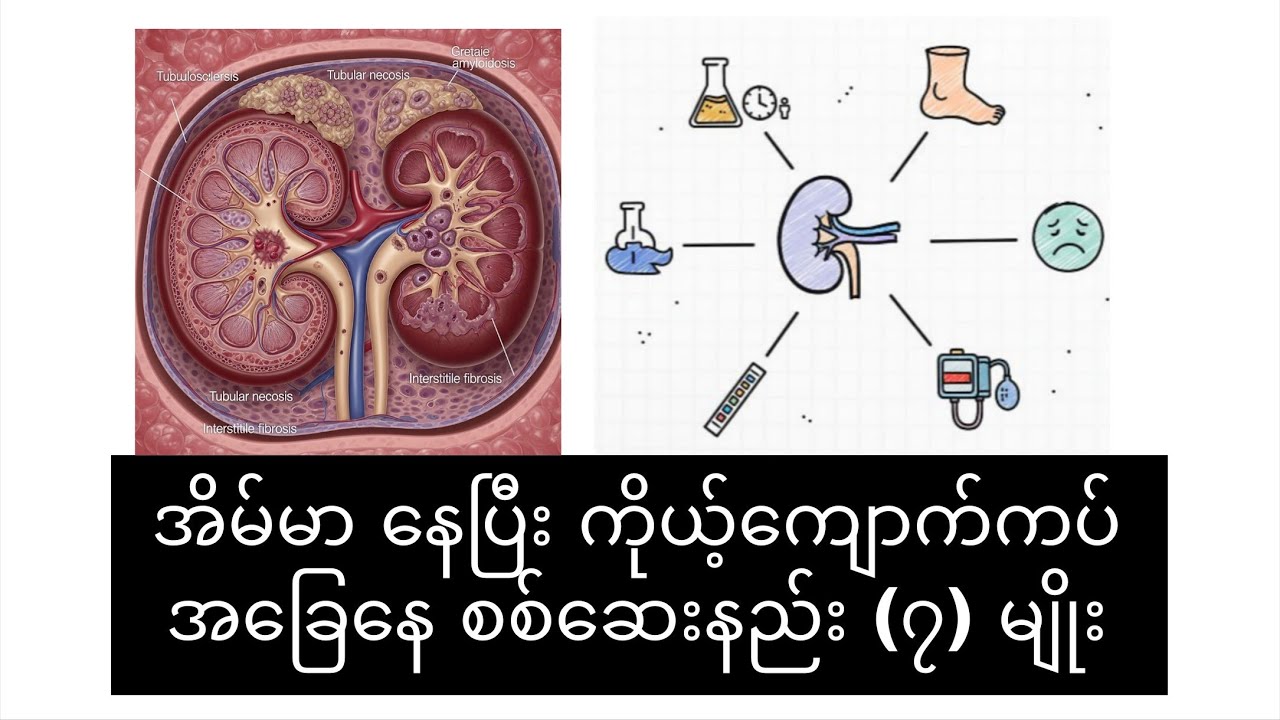 ကျောက်ကပ်ပျက်စီးနေပြီလား? ဒီလက္ခဏာ (၇) ချက်ကို သတိပြုပါ