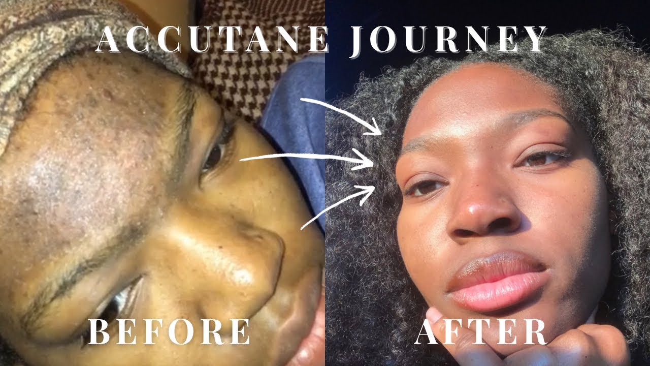 Accutane Changed My Skin FOREVER 😳 | Side Effects, Products & Before/After