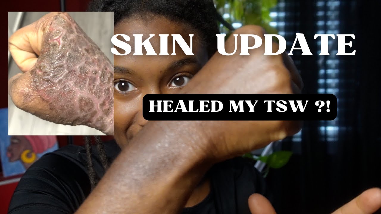 SKIN UPDATE | Healed My TSW in 3 Months?! 🧐