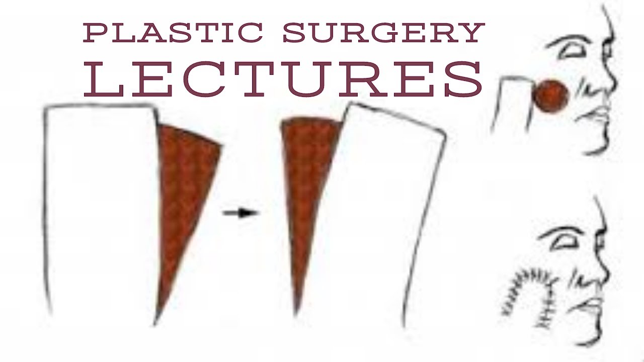 PLASTIC SURGERY lecture 1 GRAFTS types, survival and complications made easy