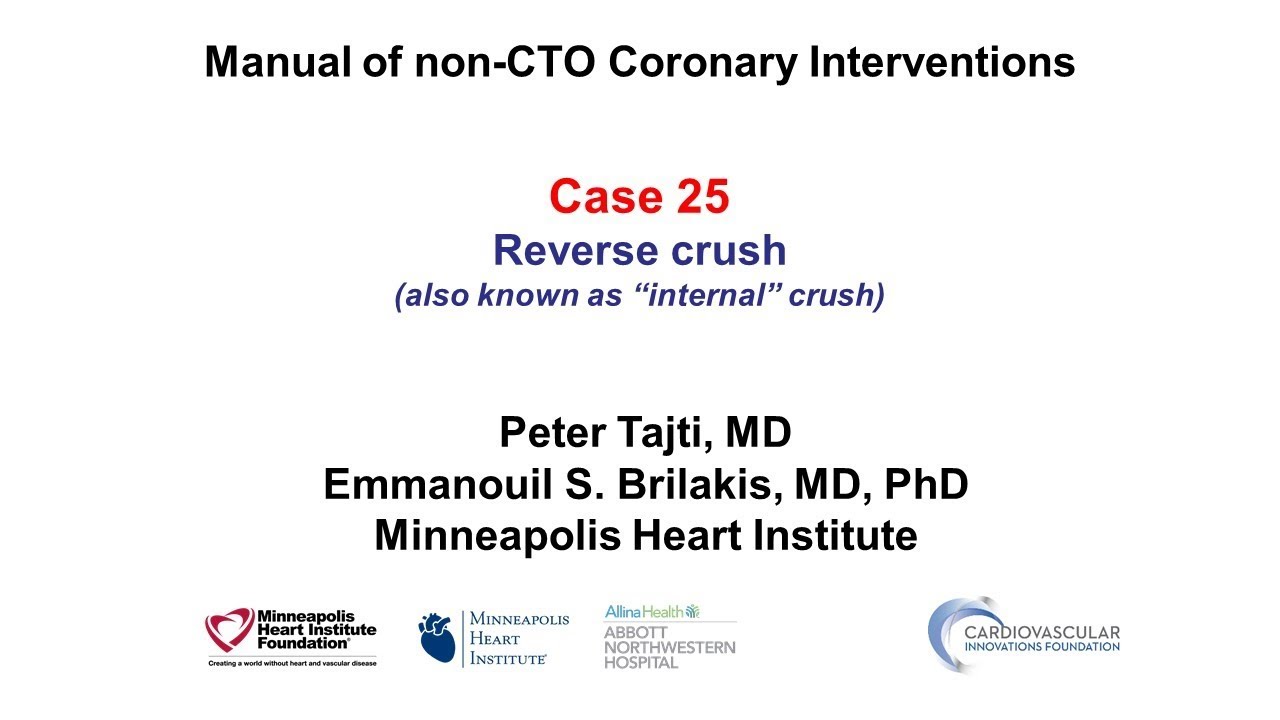 Case 25: PCI Manual: Reverse Crush