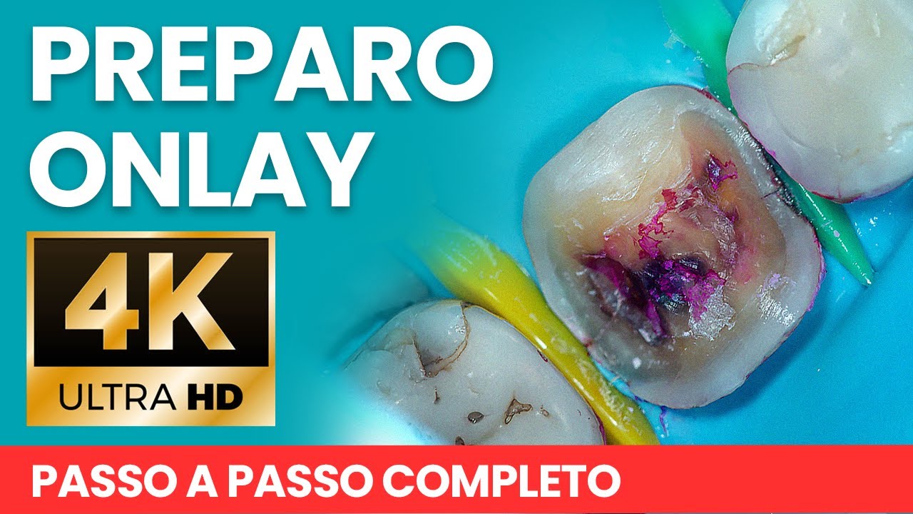 PREPARO ONLAY 4k - Mylene e Renato