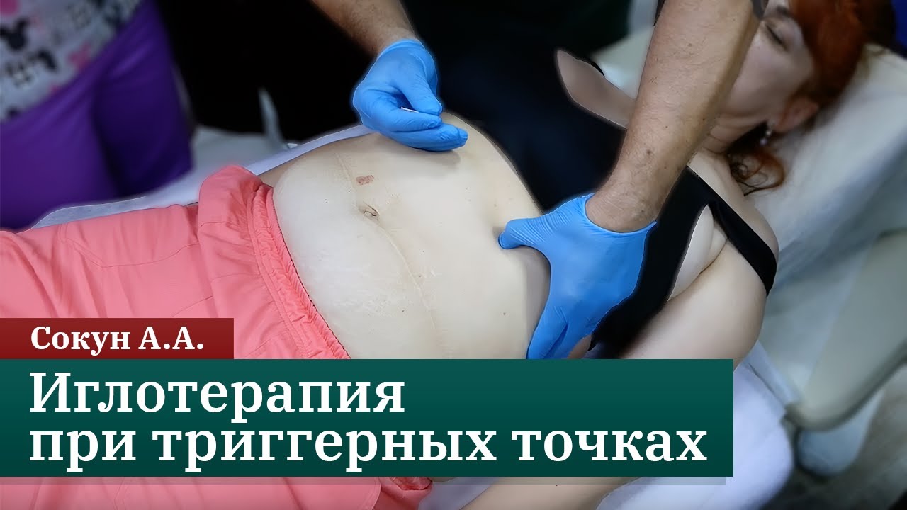 Иглотерапия при триггерных точках. Сокун. А.А.