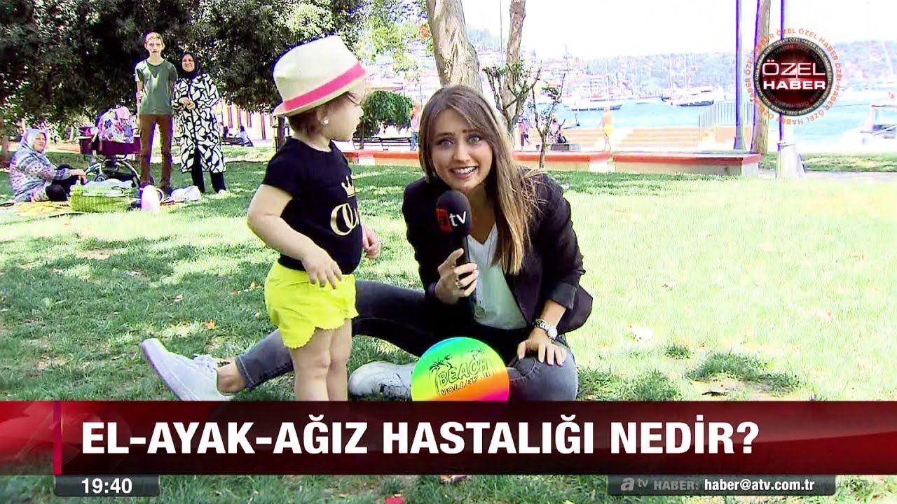 Çocuklarda el-ayak-ağız hastalığı! - 12 temmuz 2017
