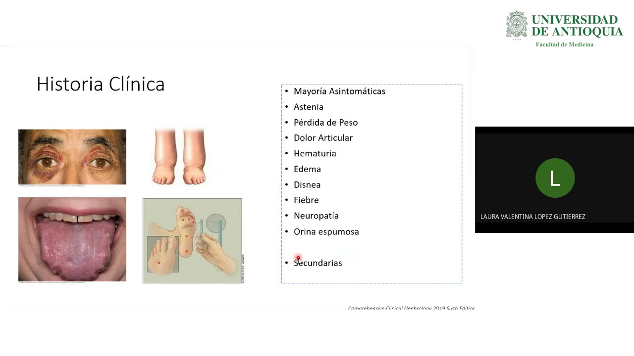 Enfoque del Paciente con Glomerulopatía - Dra. Laura Valentina López