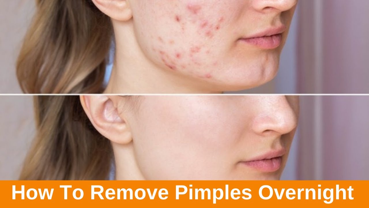 Acne treatment overnight #shorts #doublecleansing #skincare #makeupvideo #skincarevideo #shortsindia