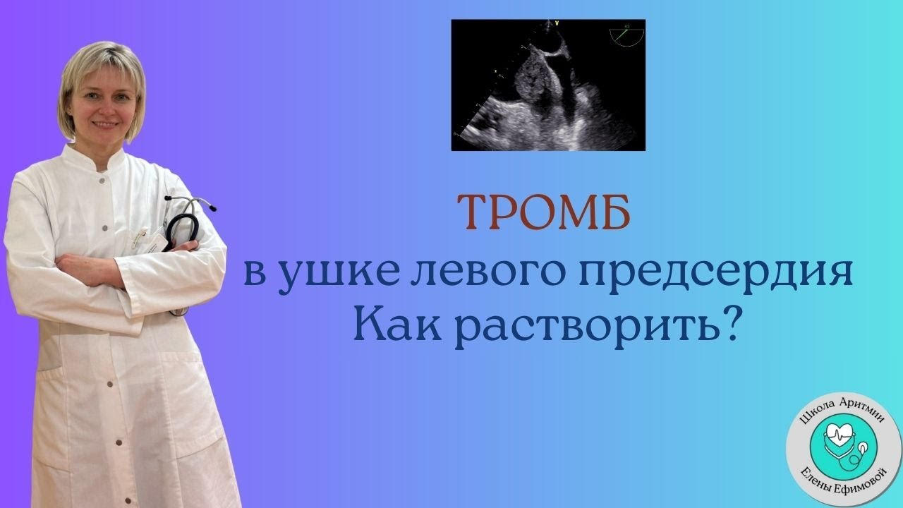 Тромб в ушке левого предсердия. Как растворить?