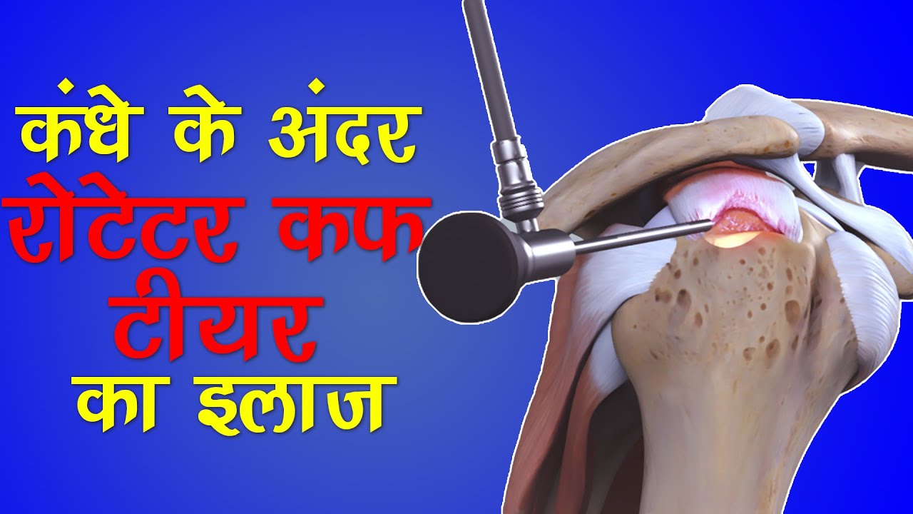 What is Rotator Cuff Tear ? Causes, Symptoms & Treatment I रोटेटर कफ क्या है और इसका इलाज क्या है ?
