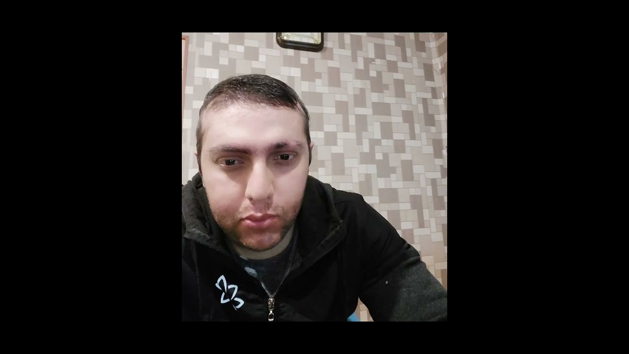 Sa&ccedil;kıran alopesiye kesin &ccedil;&ouml;z&uuml;m