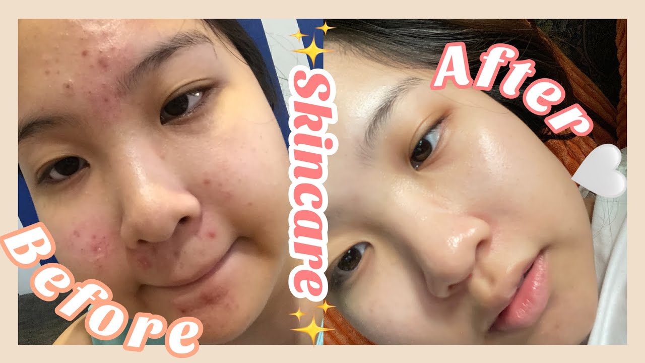 รักษาสิวด้วยตัวเอง งบไม่เยอะ กู้หน้าใส สิวหายจริง🔆