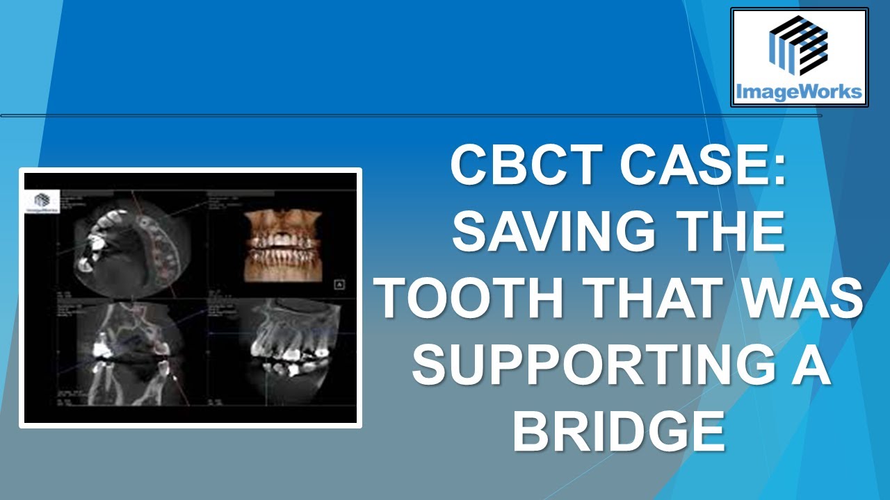 CBCT Case:  Saving the tooth that was supporting a bridge