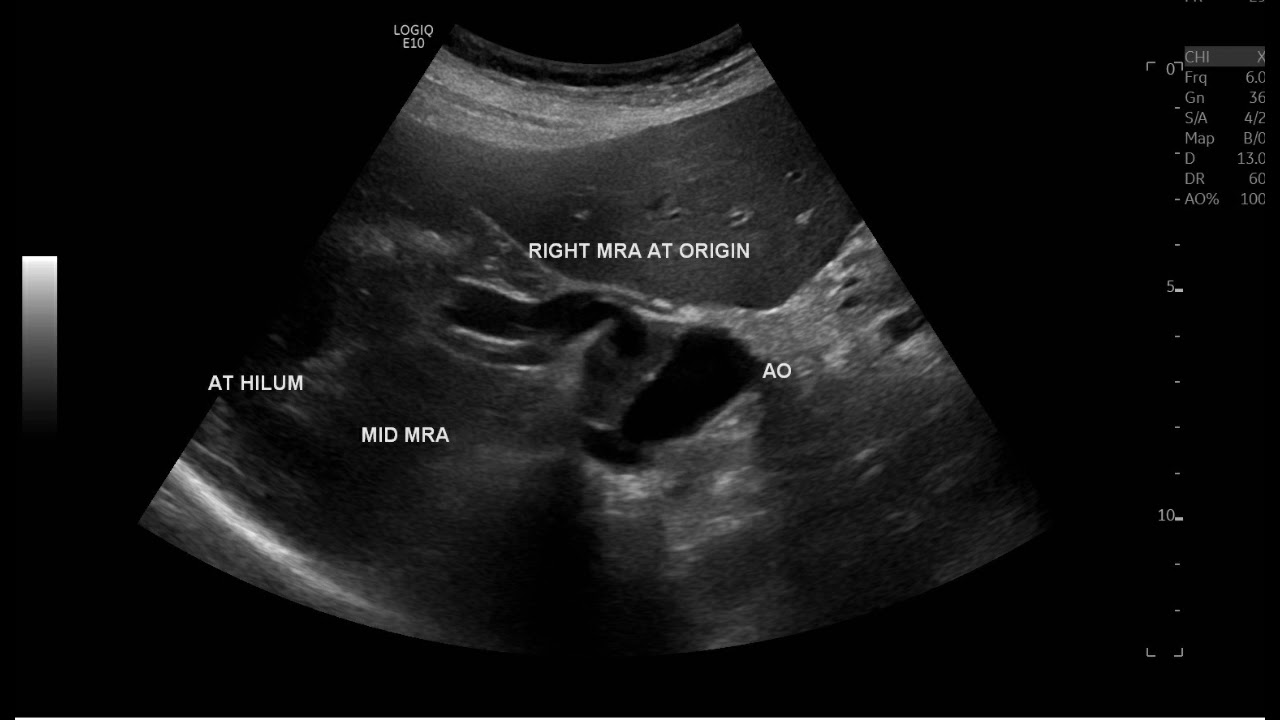Abdominal Aortic Dissection doppler ultrasound