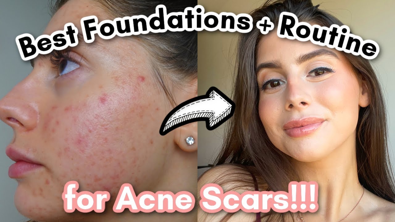 Best Foundation and Routine for Covering Acne Scars and Cystic Acne!!