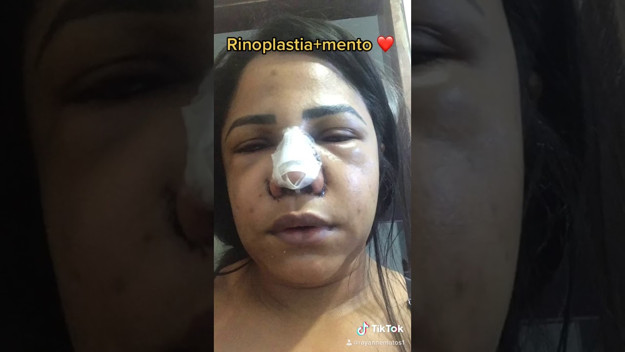 Rinoplastia nariz negroide 2020