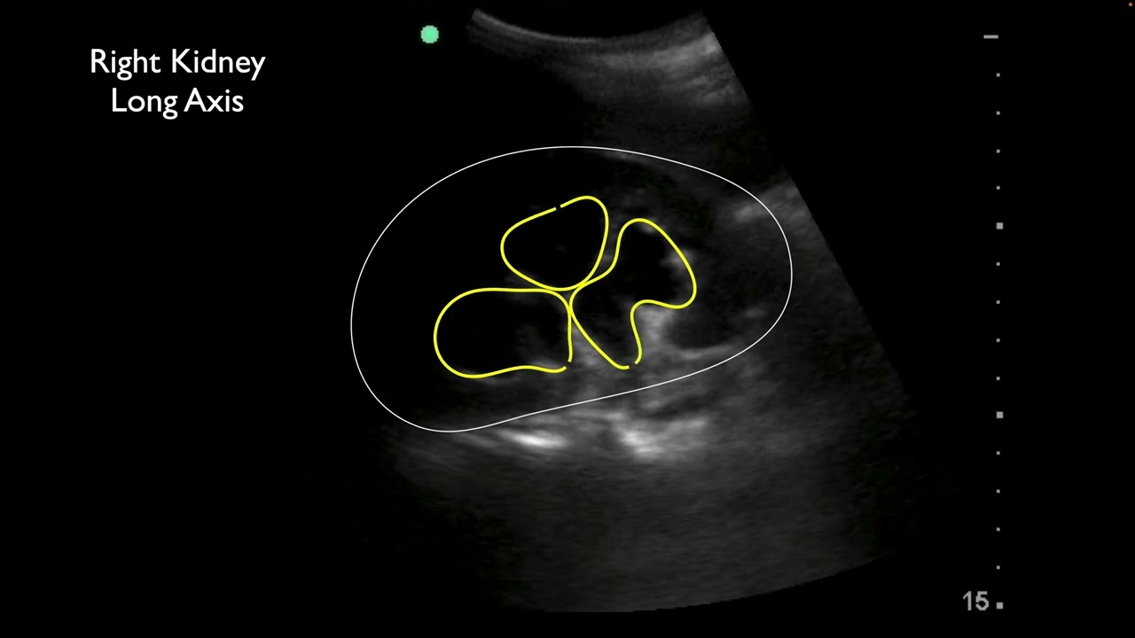Urinary Retention with Bilateral Severe Hydronephrosis