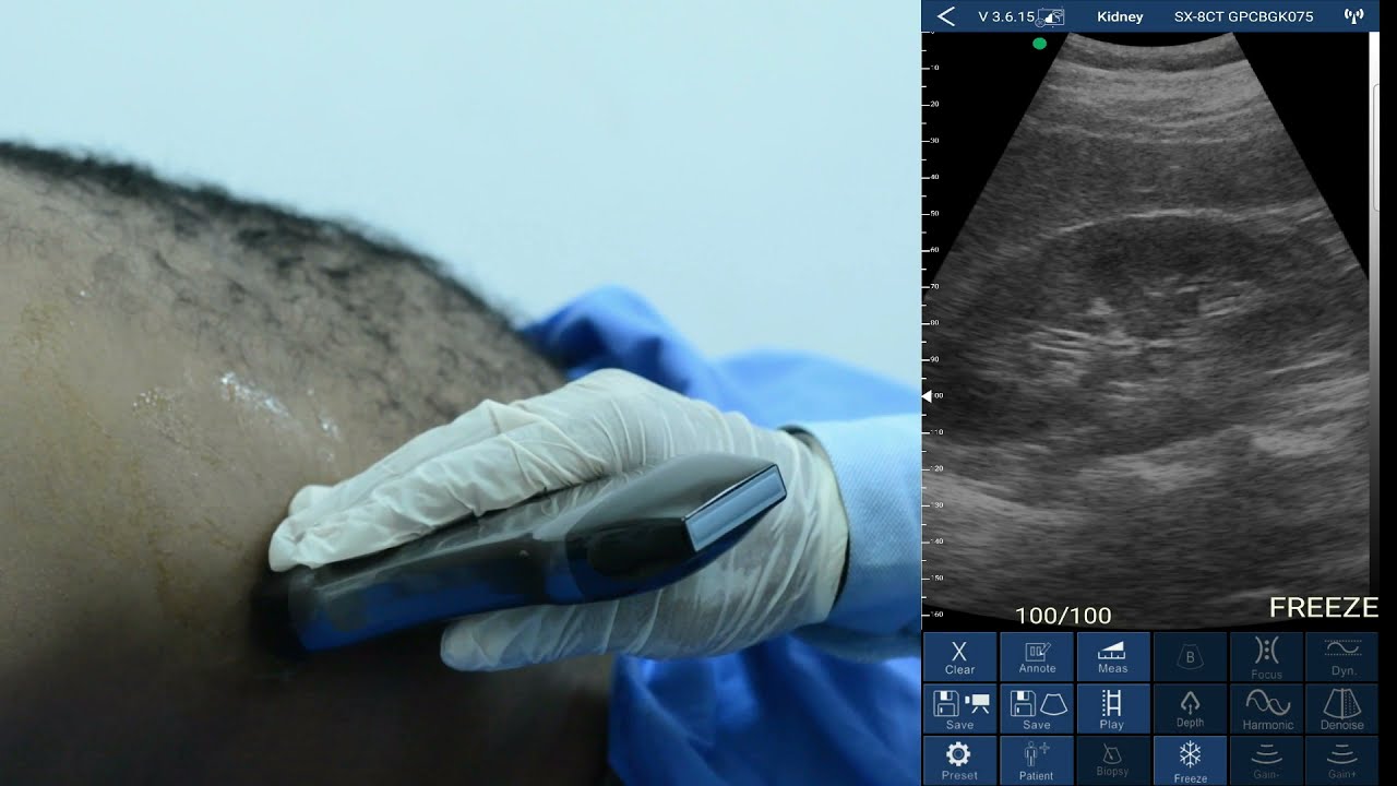 Renal Ultrasound Protocol with Eagleview Ultrasound Scanner