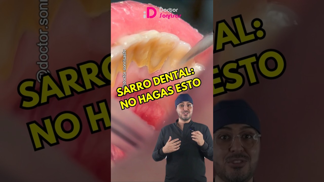 Limpieza dental URGENTE #limpiezadental #higienebucal #gingivitis #periodontitis #shorts #dentista