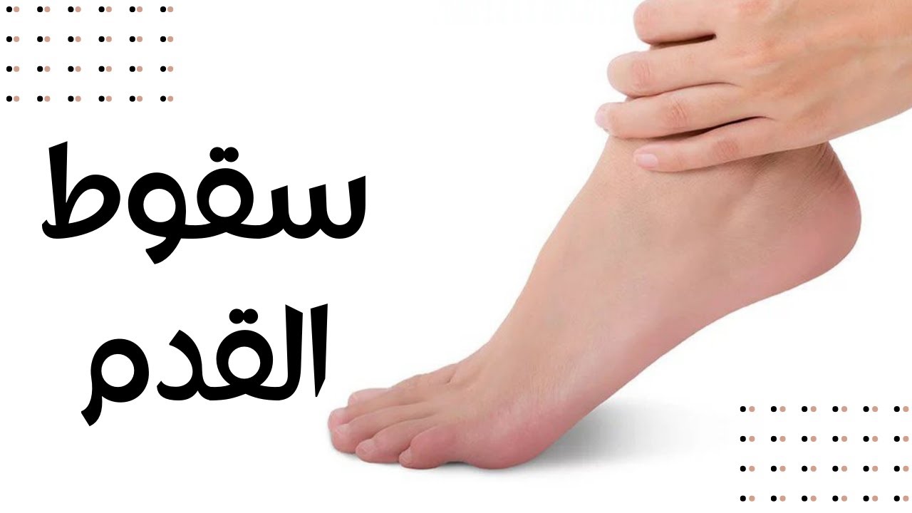 سقوط القدم - FOOT DROP: ماذا يُقصد بـ«سقوط القدم» وكيف نتعامل معه؟