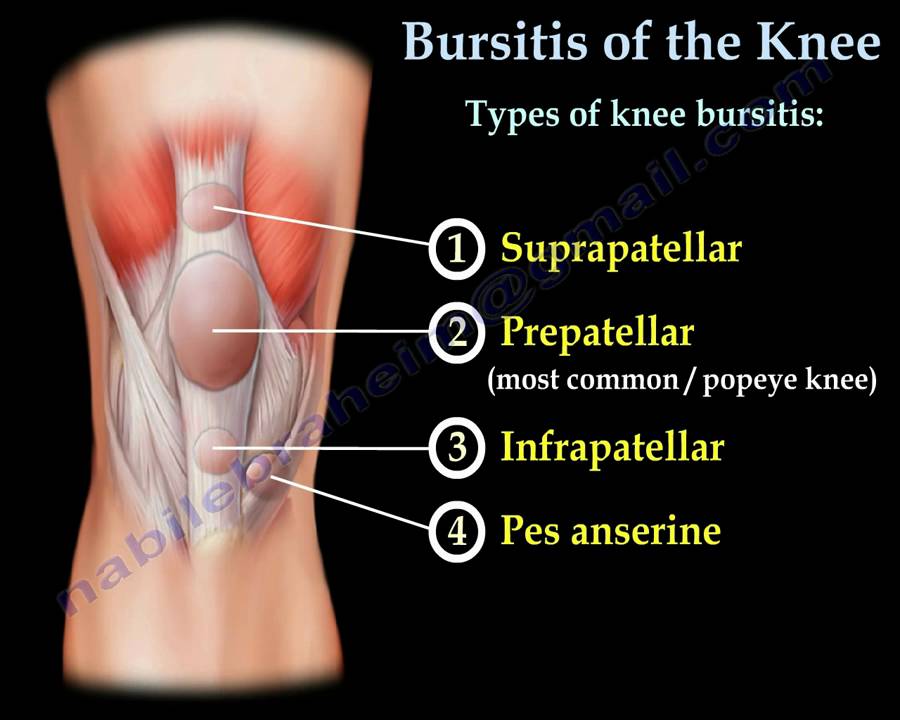 Knee Bursitis,prepatellar bursitis  - Everything You Need To Know - Dr. Nabil Ebraheim
