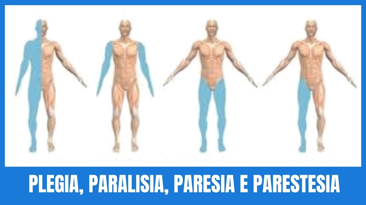 Você sabe qual a diferença entre Plegia, Paralisia, Paresia e Parestesia?