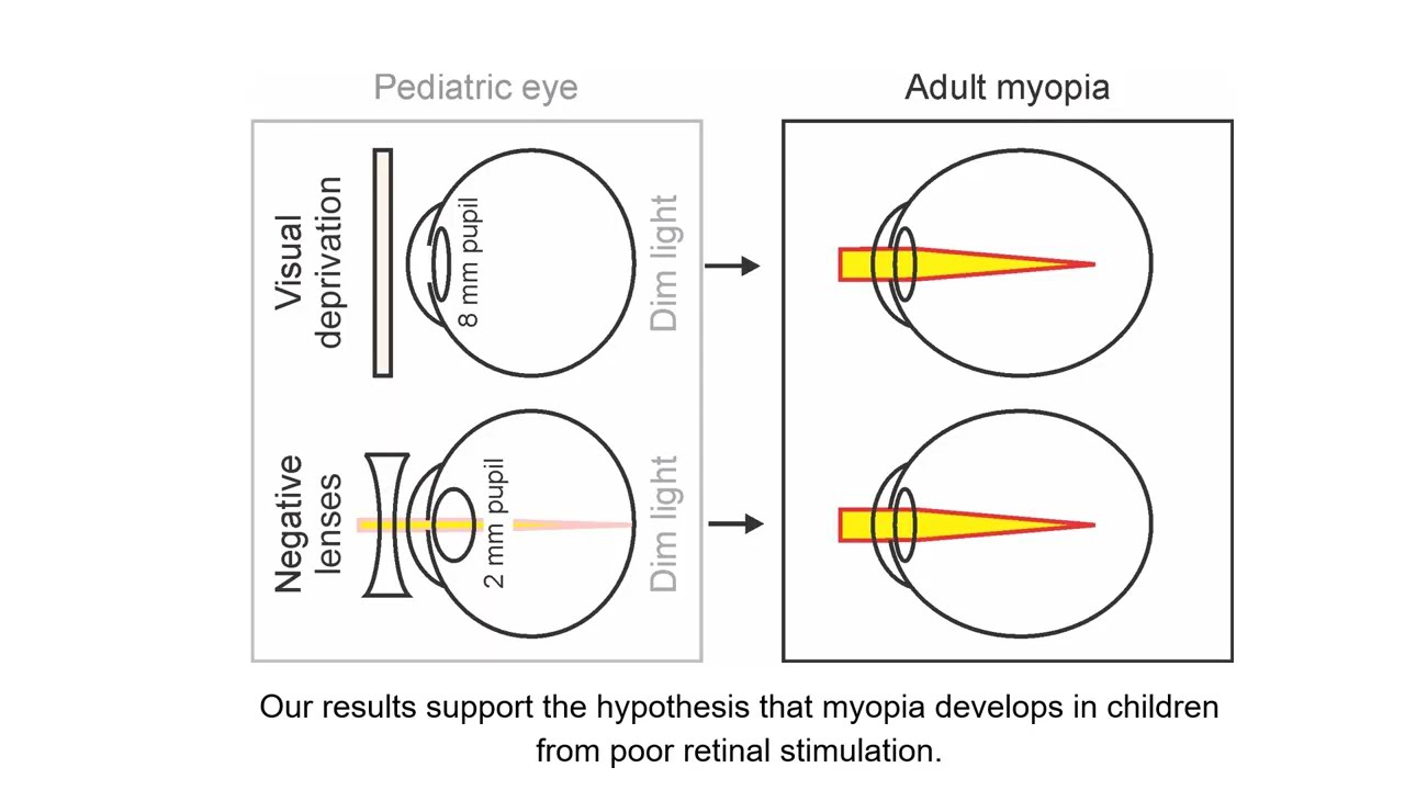 Accommodative visuomotor function driven by contrast through ON/OFF pathways & enhanced in myopia