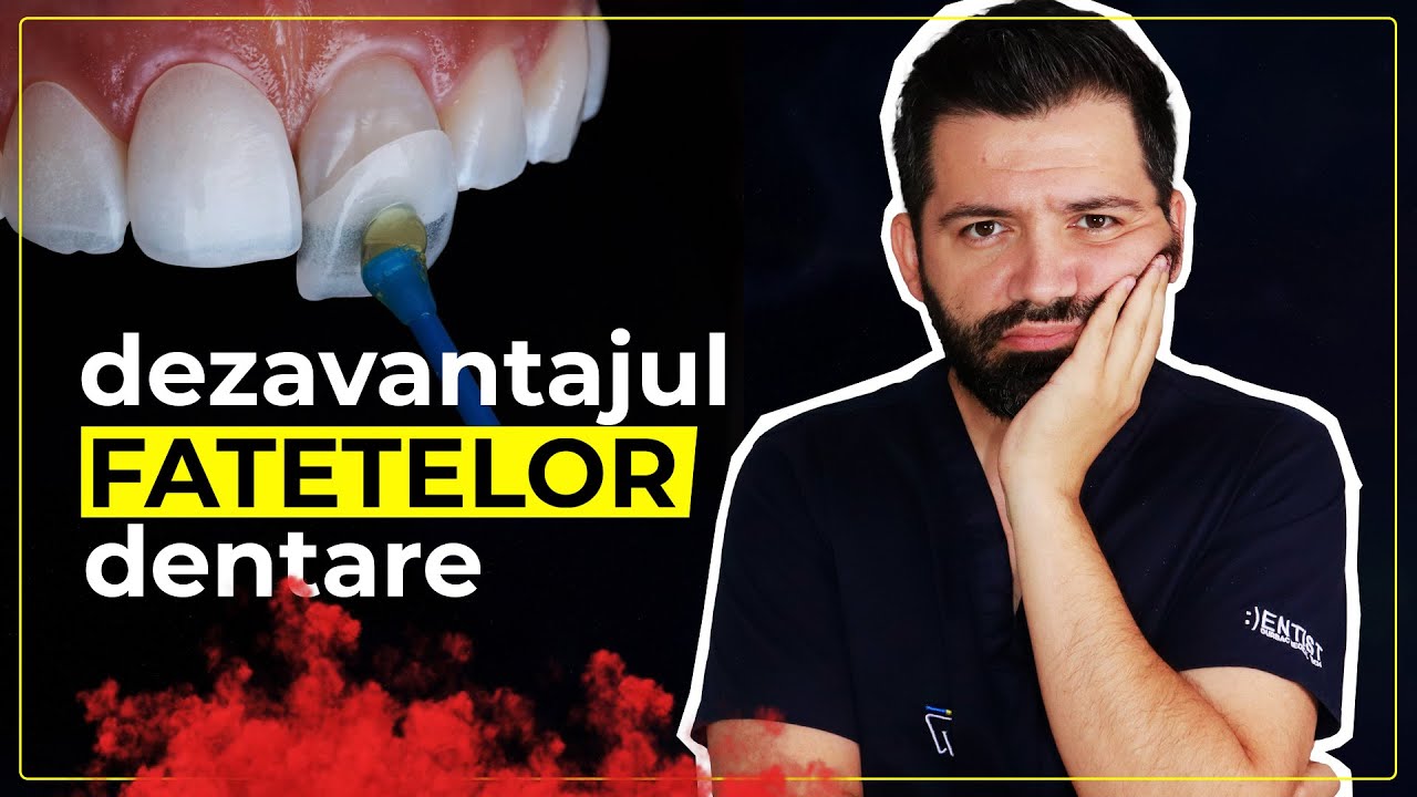 DEZAVANTAJELE Fatetelor Dentare. Poate ca nu este cazul sa-ti pui!