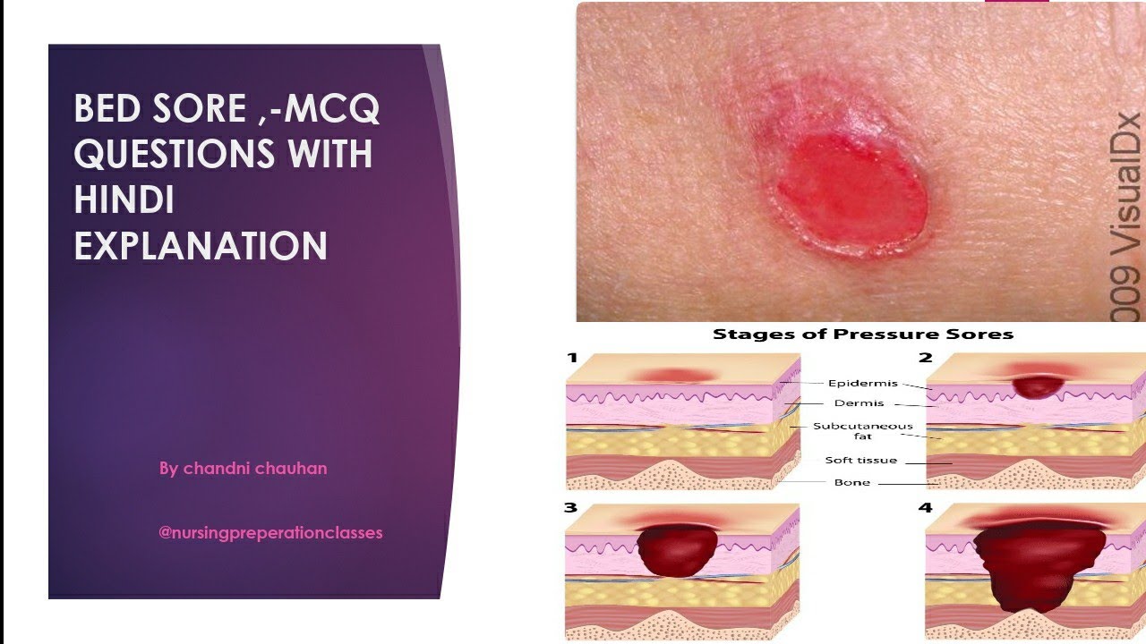 Bed sore / pressure sore mcq( hindi explanation)