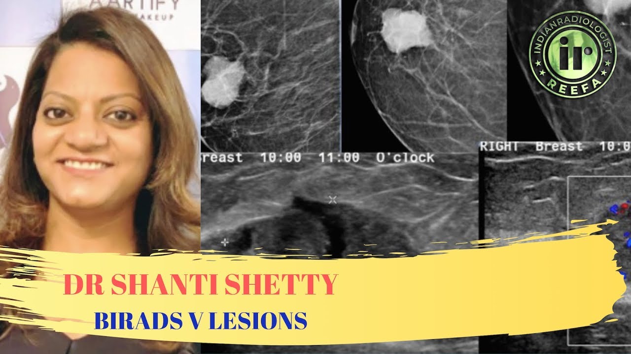 TMT: BIRADS V Lesions by Dr Shanti Shetty