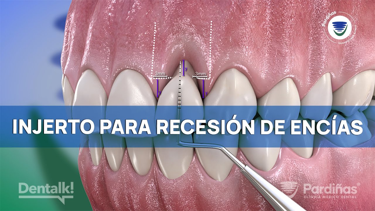 INJERTO de TEJIDO conectivo para tratar la RECESIÓN de ENCÍAS | Procedimiento paso a paso ©