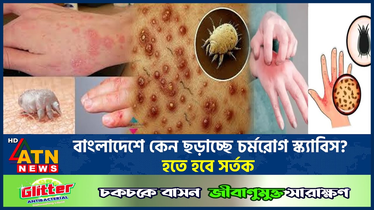বাংলাদেশে কেন ছড়াচ্ছে চর্মরোগ স্ক্যাবিস? হতে হবে সর্তক | Scabis Spreading in Bangladesh | ATN News