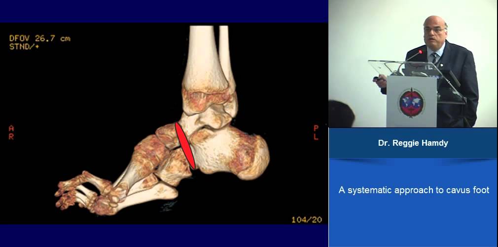 A SYSTEMATIC APPROACH TO CAVUS FOOT