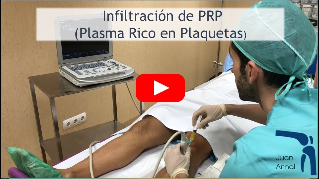 Infiltración Plasma Rico en Plaquetas (PRP) en TENDÓN ROTULIANO