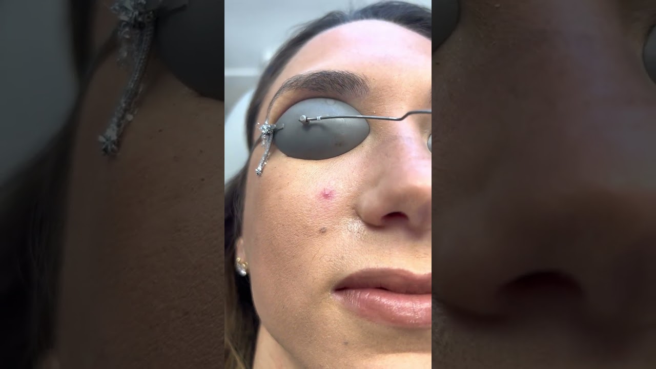 Vbeam Treatment of Spider Angioma