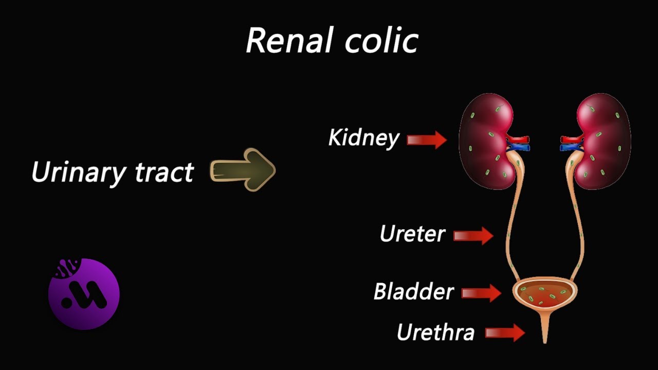 Renal colic - Symptoms and treatment