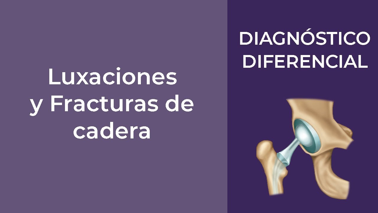 Diagnóstico Diferencial. Luxaciones y Fracturas de cadera