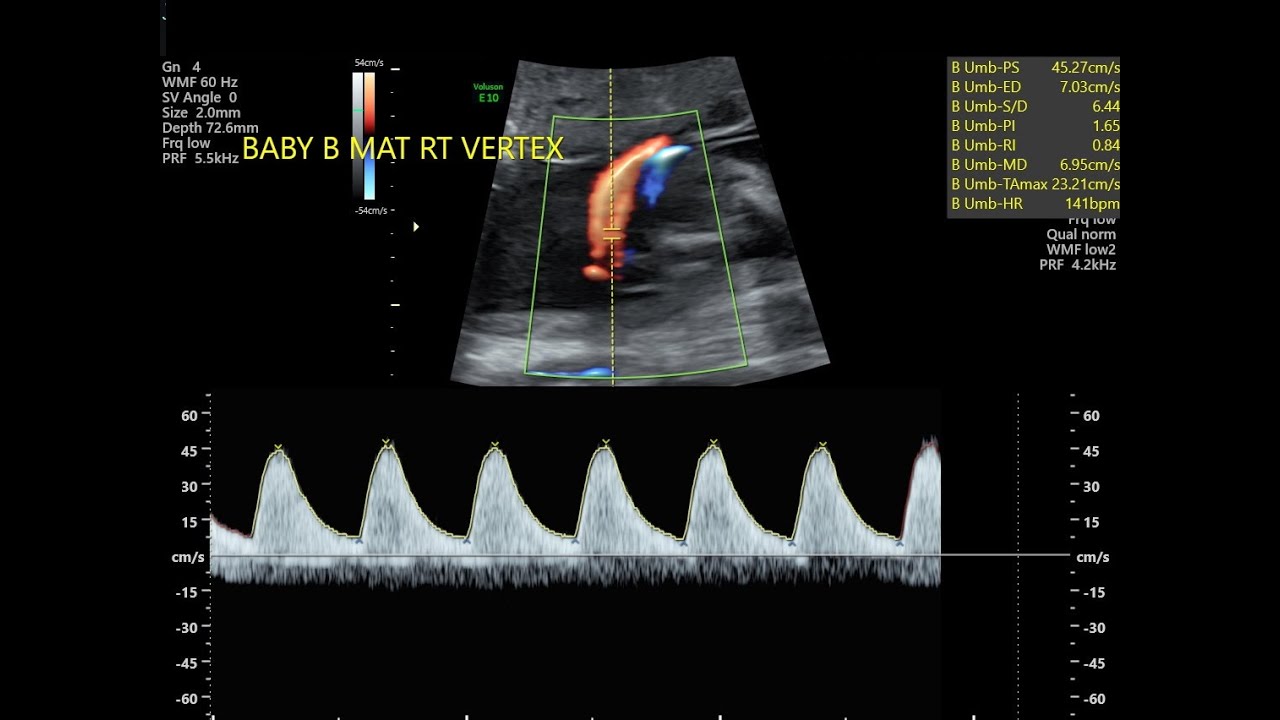 Doppler Index S-D Ratio (Systolic / Diastolic);  key measurement in obstetric ultrasound