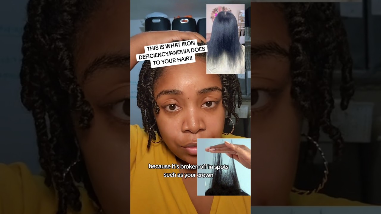 This is what IRON DEFICIENCY/ANEMIA does to your HAIR!! #haircare #naturalhair #irondeficiency