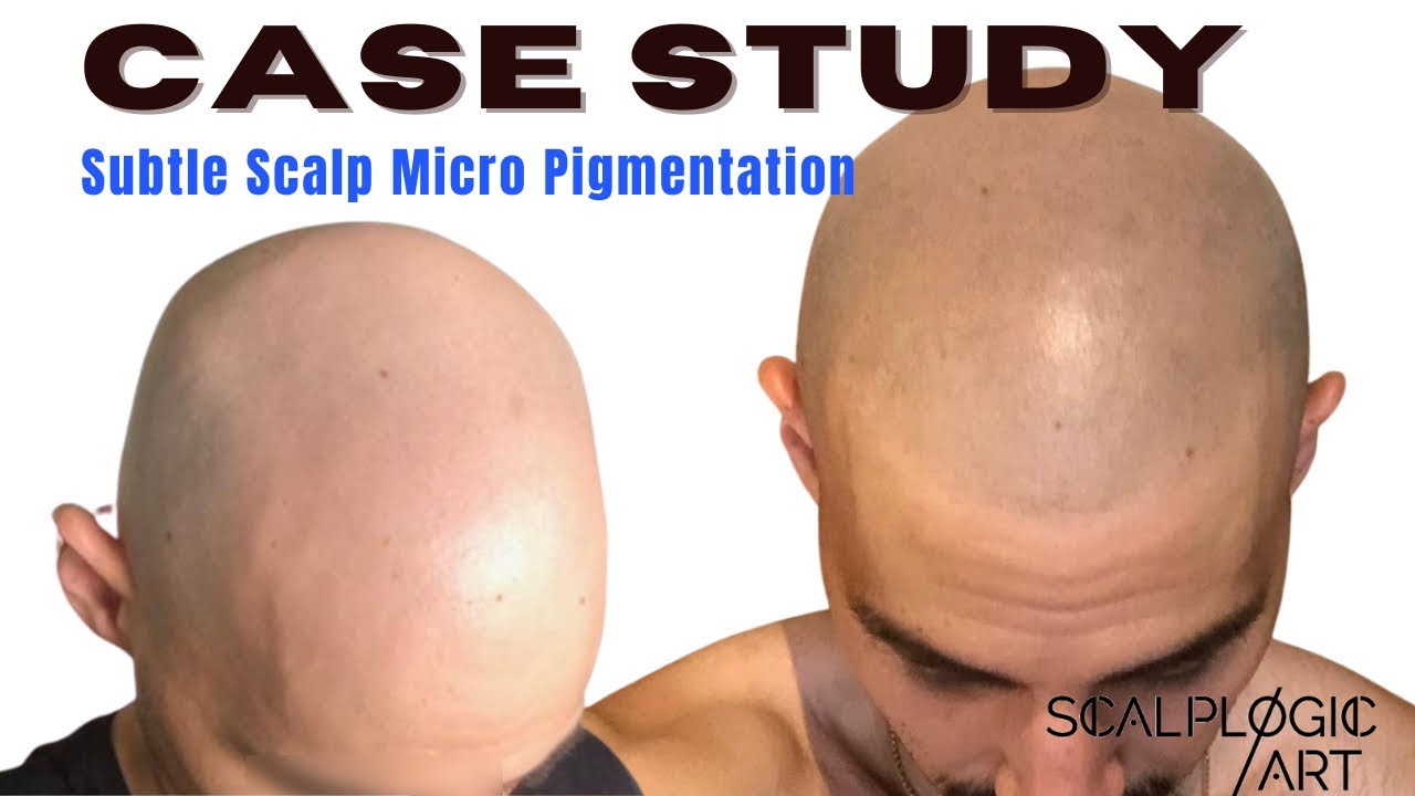 Scalp MicroPigmentation Case Study| Before - After - Healed