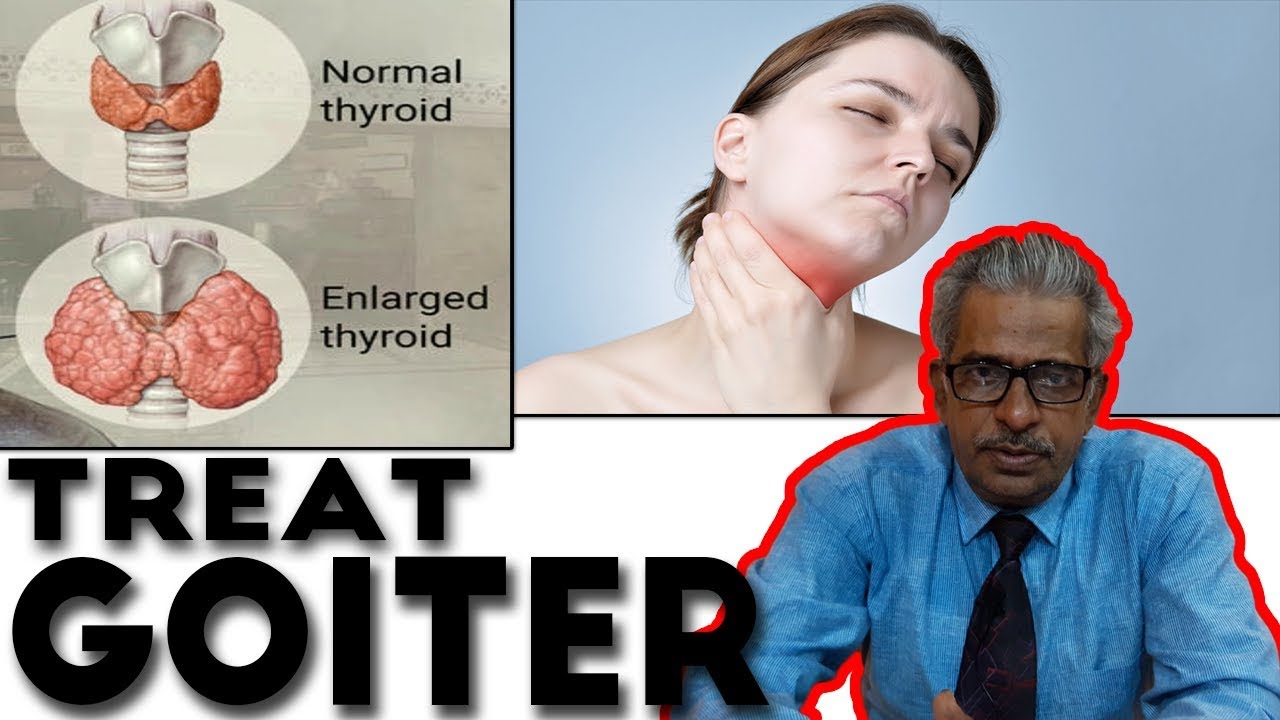 Goiter Treatment in Homeopathy by Dr. P.S. Tiwari