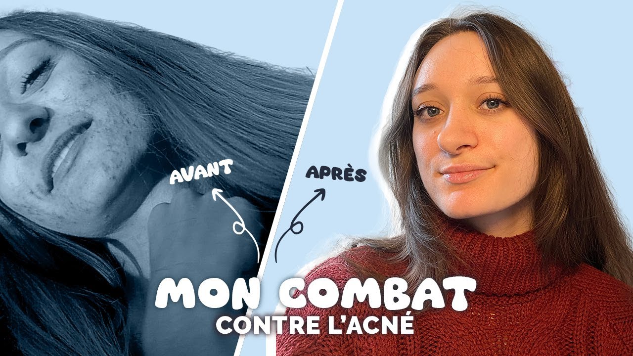 13 Ans d'Acné Sévère : Ce qui a ENFIN guéri ma peau (et ce n'est pas Roaccutane) I Haethna