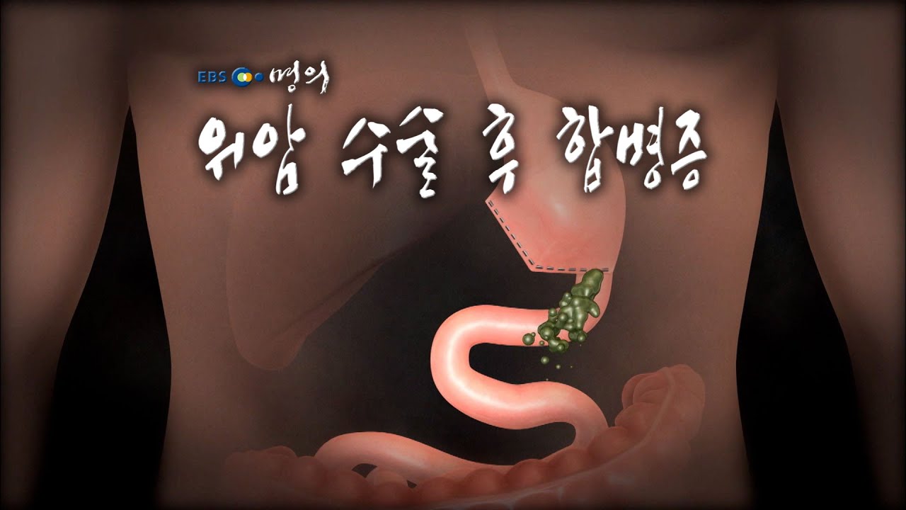 [명의 의학백과📖] 위암 수술 후 합병증