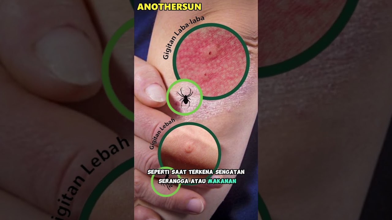 Kenapa Kulit Merasakan Gatal?