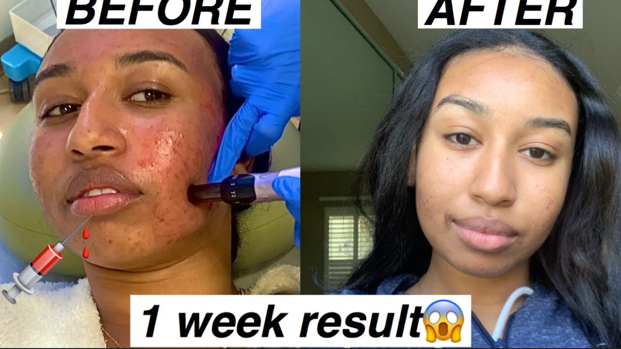 My First Microneedling Experience | Removes Acne Scars & Dark Spots| One Week Results